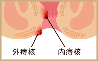 痔の種類