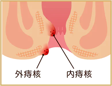 痔の種類