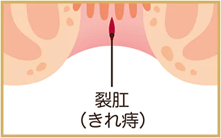 痔の種類
