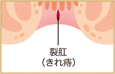 痔の種類