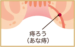 痔の種類