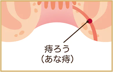 痔の種類
