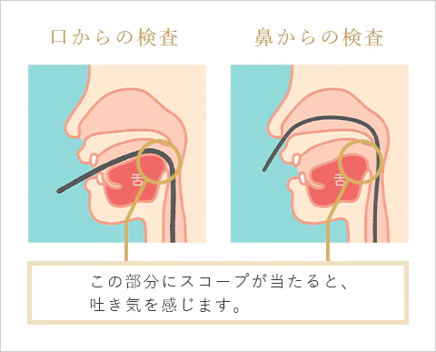 経鼻内視鏡検査で楽に受けられる